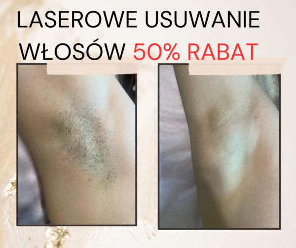 depilacja laserowa wrocław Depil Ekspert